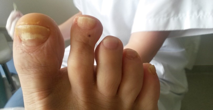 Effets secondaires des traitements en cancérologie.Syndrome Mains / Pieds : Incidence sur la peau et les phanères.
